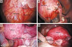 endometriosis