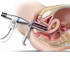gynaecological endoscopy