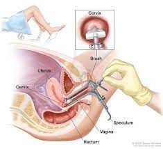 pap smear