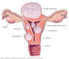 uterine fibroid